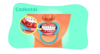 Câncer na gengiva: sintomas, diagnóstico e prevenção.