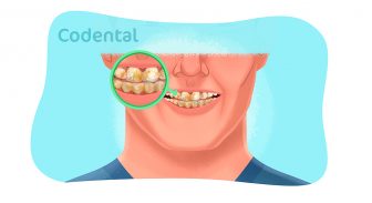 Fluorose dentária: o que é, como prevenir e muito mais