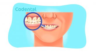 Hipoplasia de esmalte: tudo que você precisa saber!