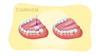 Bloco dentário: descubra tudo sobre essa restauração!