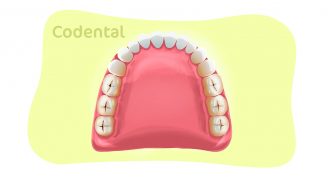 Cárie dentária: tudo o que precisa saber sobre!