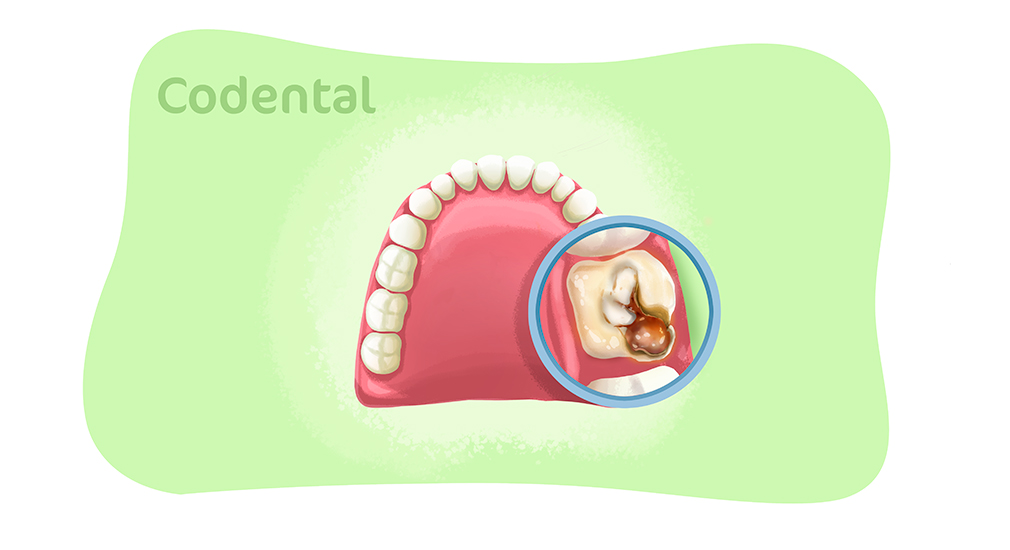 Dente furado