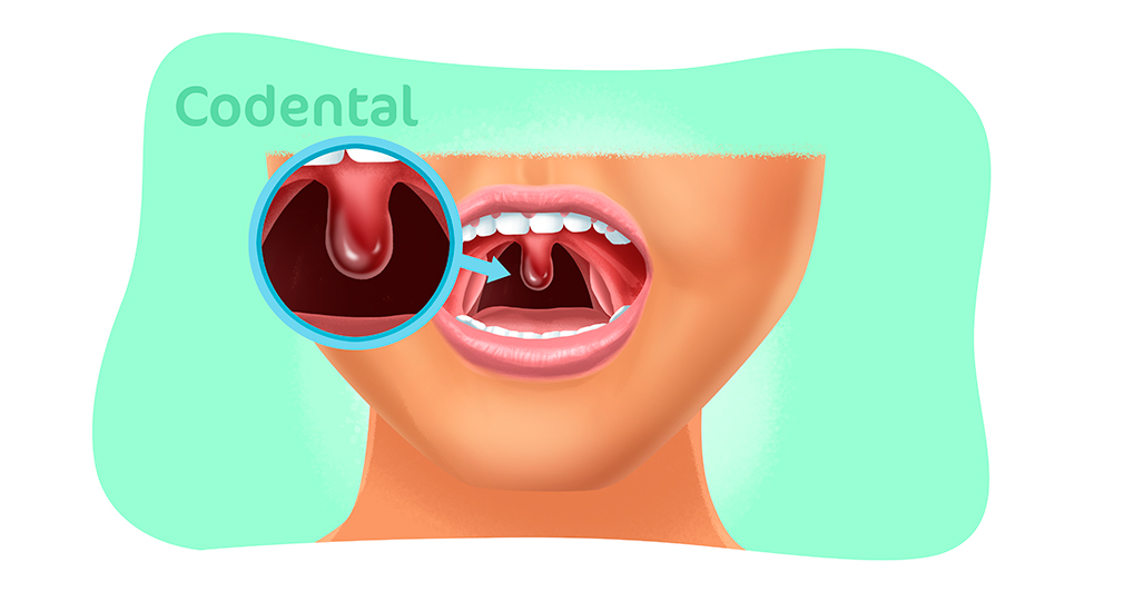 uvula inchada