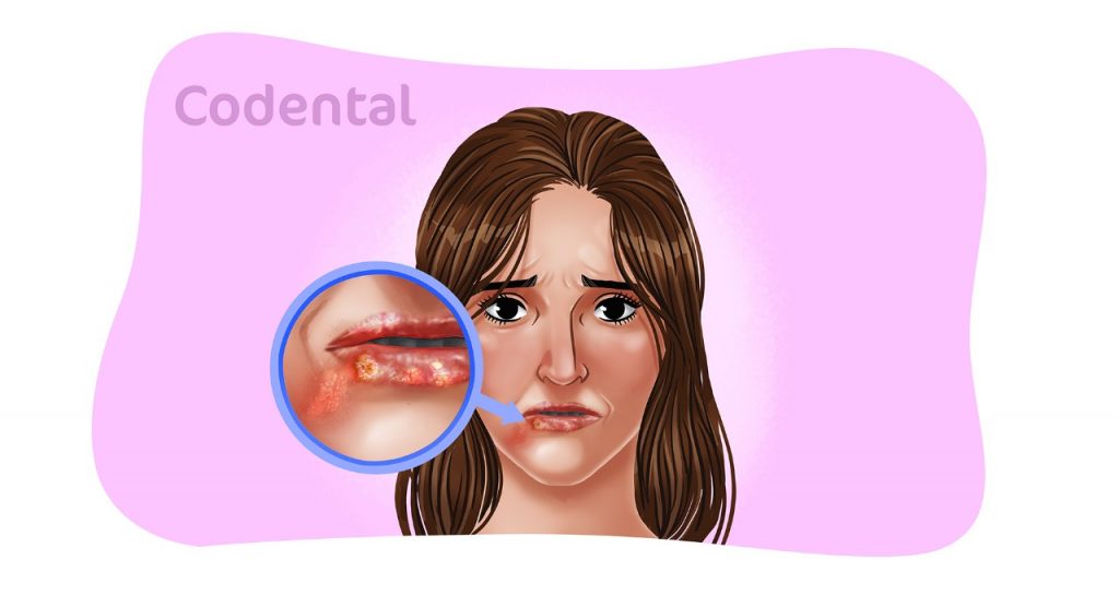 Herpes emocional