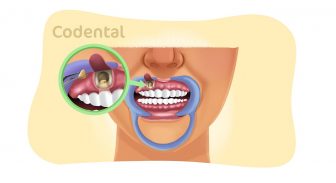 Apicectomia: saiba tudo sobre essa condição!