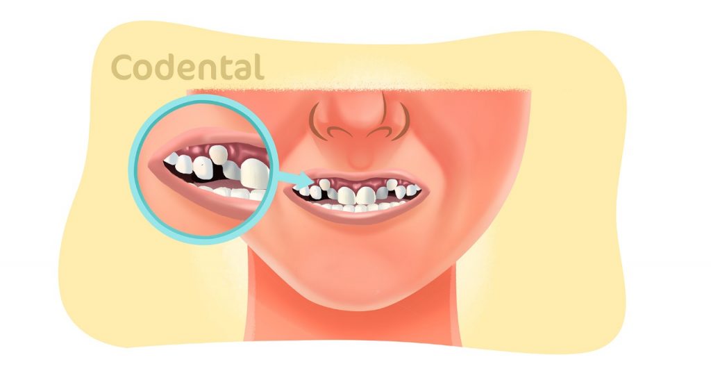 Dente encavalado