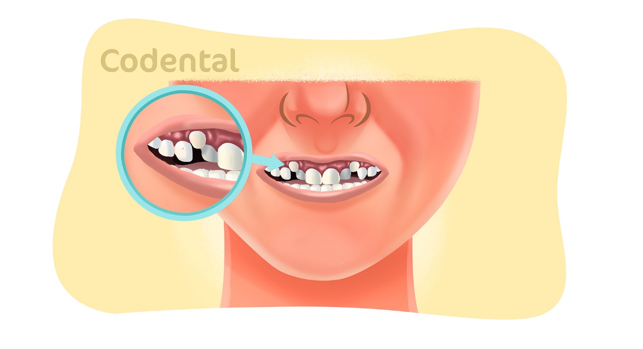 Dente encavalado