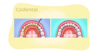 Como retirar tártaro dos dentes?