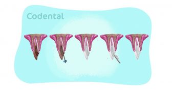 Clareamento dentário interno: tudo que você precisa saber!
