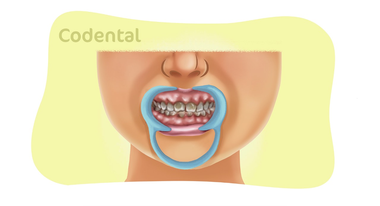 dentinogenese imperfeita