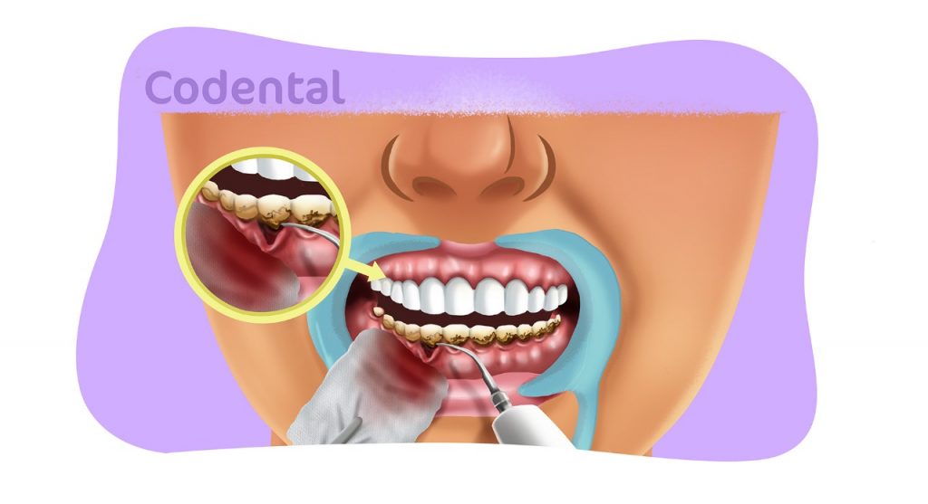 Desbridamento na odontologia