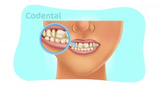 Falta de cálcio nos dentes: tudo que você precisa saber sobre!