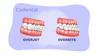Overjet e Overbite na odontologia: descubra tudo sobre!
