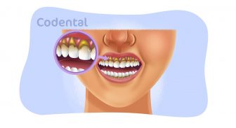 Lesões cervicais não cariosas: um guia completo!