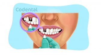 Dente provisório