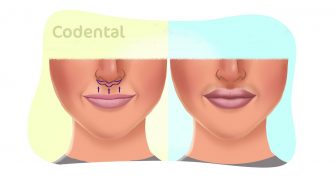Lip Lift: um guia completo sobre o assunto!