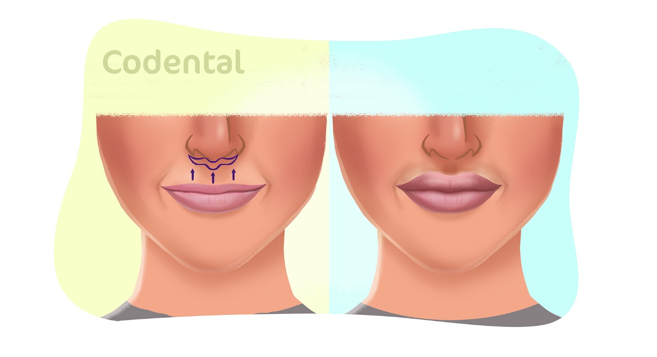 Lip Lift