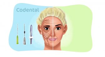 Fios de PDO na odontologia: tudo o que você precisa saber