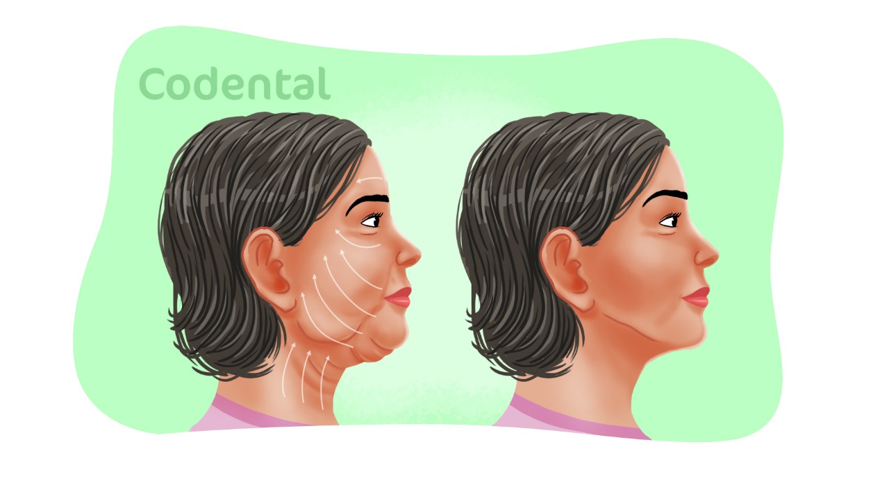 Lifting facial