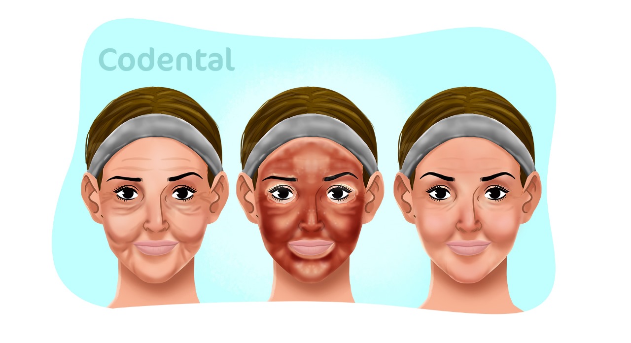 peeling de fenol