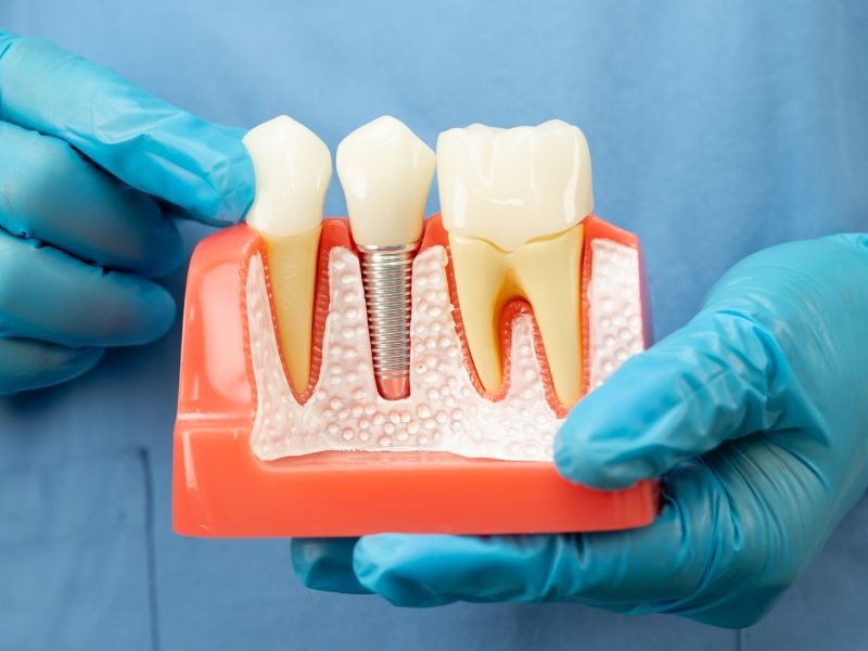 peri implante o que é