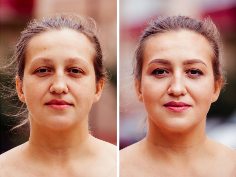 radiofrequência facial antes e depois